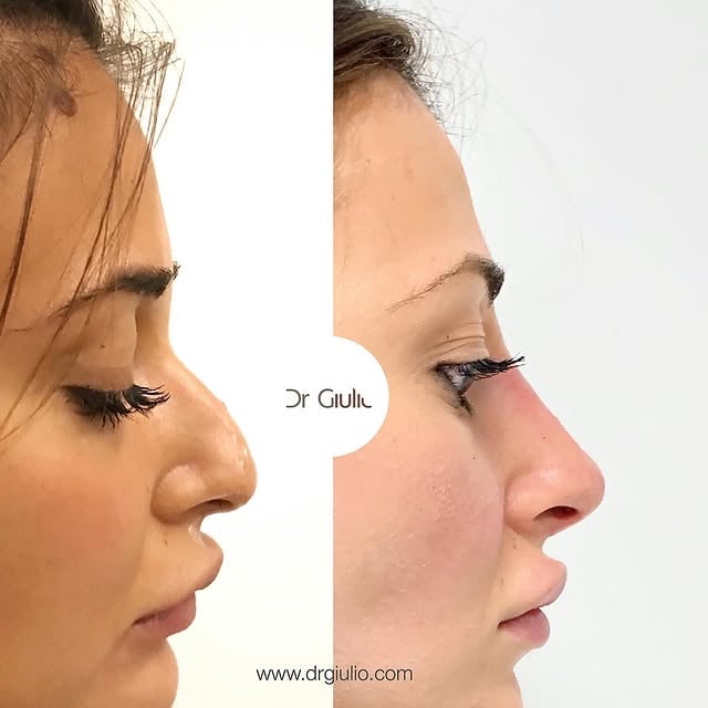 Back to work 👨🏻‍⚕️💉👃 #Rinofiller Magic ✨ What do you guys think about this result? I love it ❤️ #nonsurgicalnosejob .Before pic was 2 years ago, After pic is now after third session (she got her mole surgically removed in the meanwhile).🇮🇹 Cosa ne pensate di questo risultato? Ripetendo il trattamento nel tempo (questa paziente è venuta una volta ogni anno) siamo riusciti ad ottenere un graduale sollevamento della punta con un incredibile cambiamento di forma 💉👃❤️