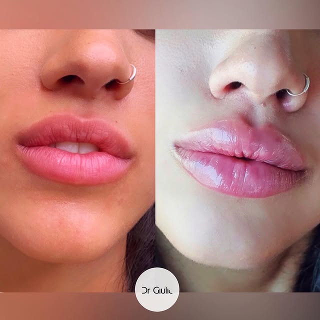 #lipfiller for this stunning beauty 💉💋🔥 Volume, Idratazione, Definizone e Correzione delle irregolarità del trattamento precedente. Che ne pensate di questo risultato? Do you like it? 👨🏻‍⚕️❤️💋#fillerlabbra #lips #lipsfiller #beforeandafter #beauty #medicinaestetica #doctor #injector #hialuronicacid #labbra #natural #sexy #plump #drgiulio